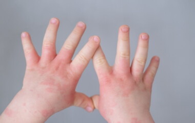 Tips Mengatasi Alergi Dingin Pada Anak yang Perlu Diketahui 